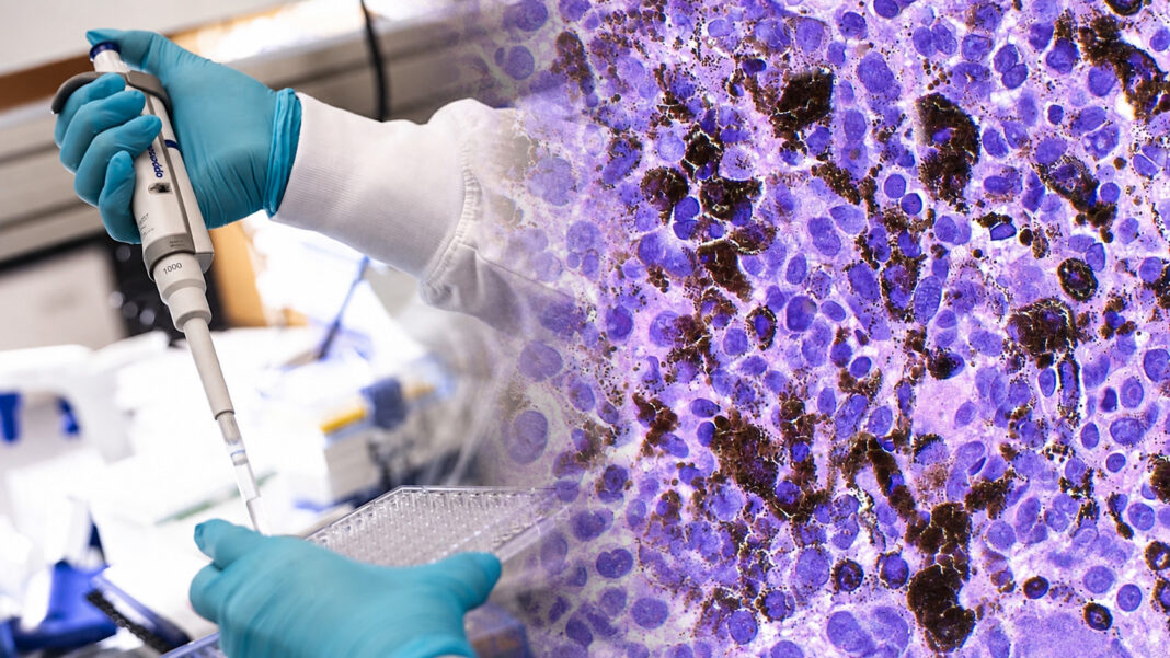melanoma